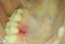 吃伊丽莎白瓜上牙膛痒,舌尖上的痒意之旅